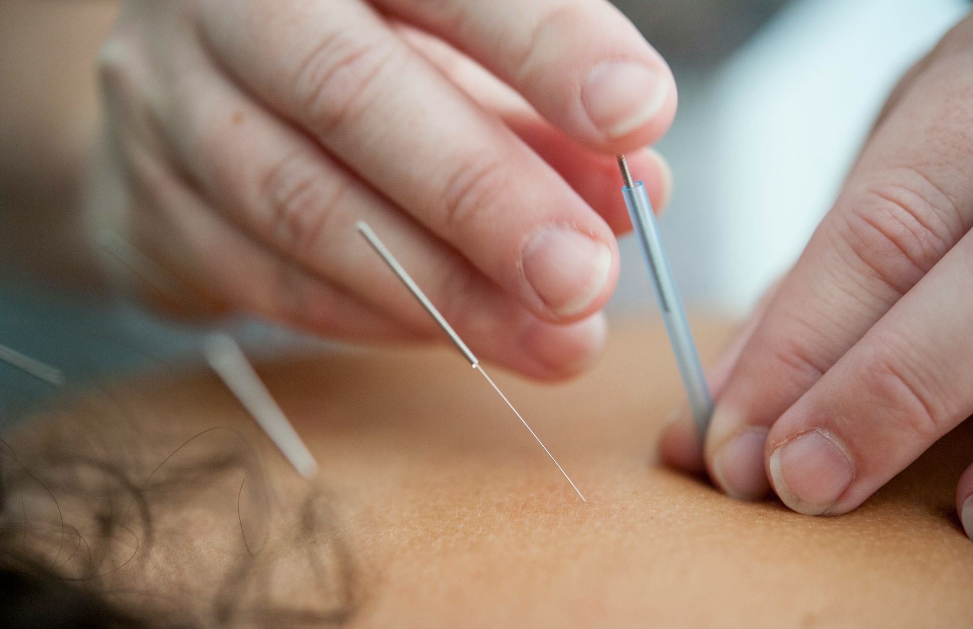 acupuncture needles inserted into skin